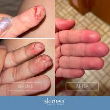 Skinesa Probiotic